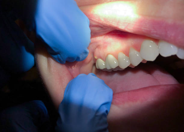 Best Knocked-Out Tooth (Avulsed Tooth) Treatment in Lacon, IL